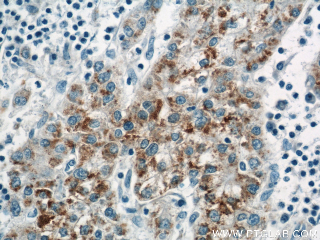 Immunohistochemistry (IHC) staining of human liver cancer tissue using ACAA1 Polyclonal antibody (12319-2-AP)