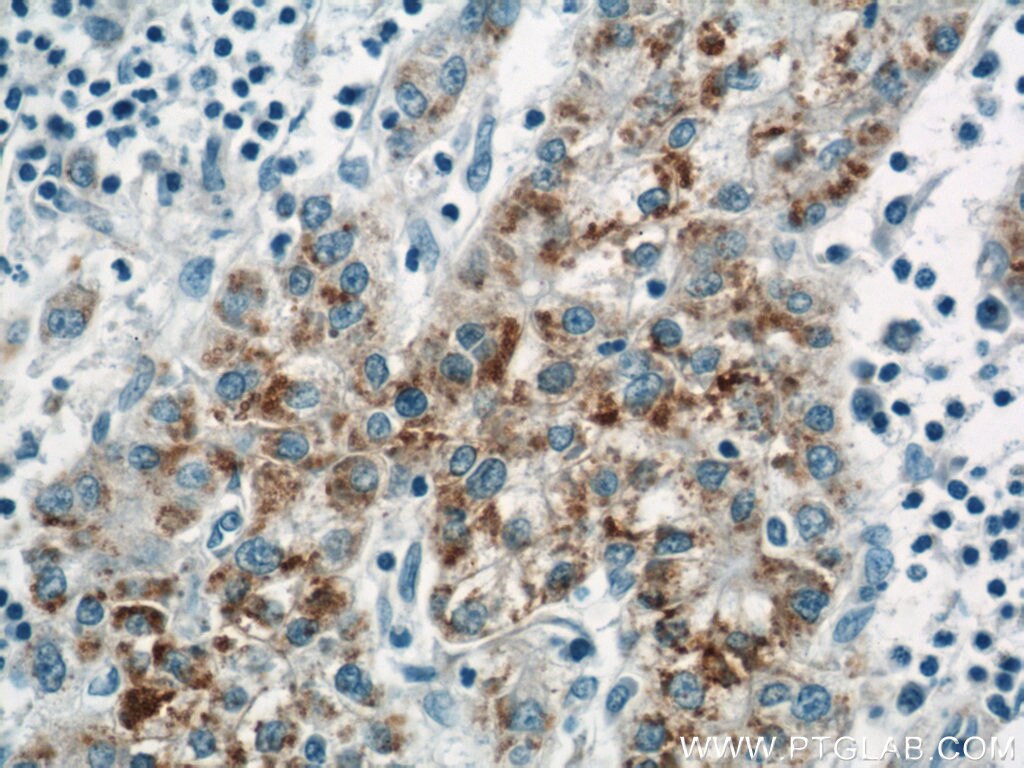 Immunohistochemistry (IHC) staining of human liver cancer tissue using ACAA1 Polyclonal antibody (12319-2-AP)