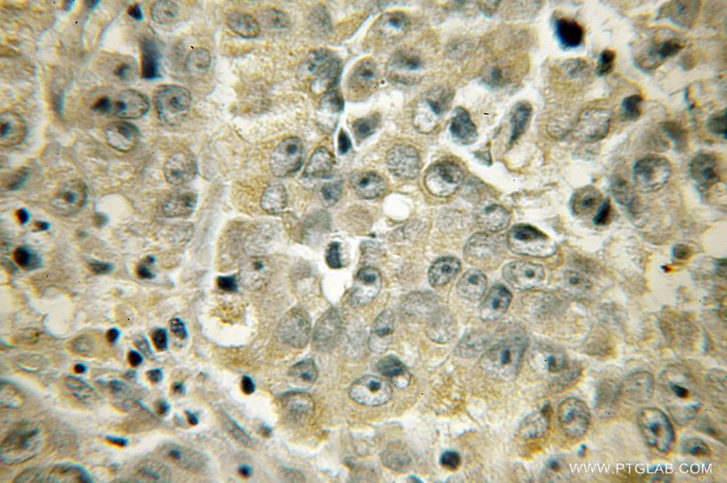 Immunohistochemistry (IHC) staining of human prostate cancer tissue using ACAA1 Polyclonal antibody (12319-2-AP)