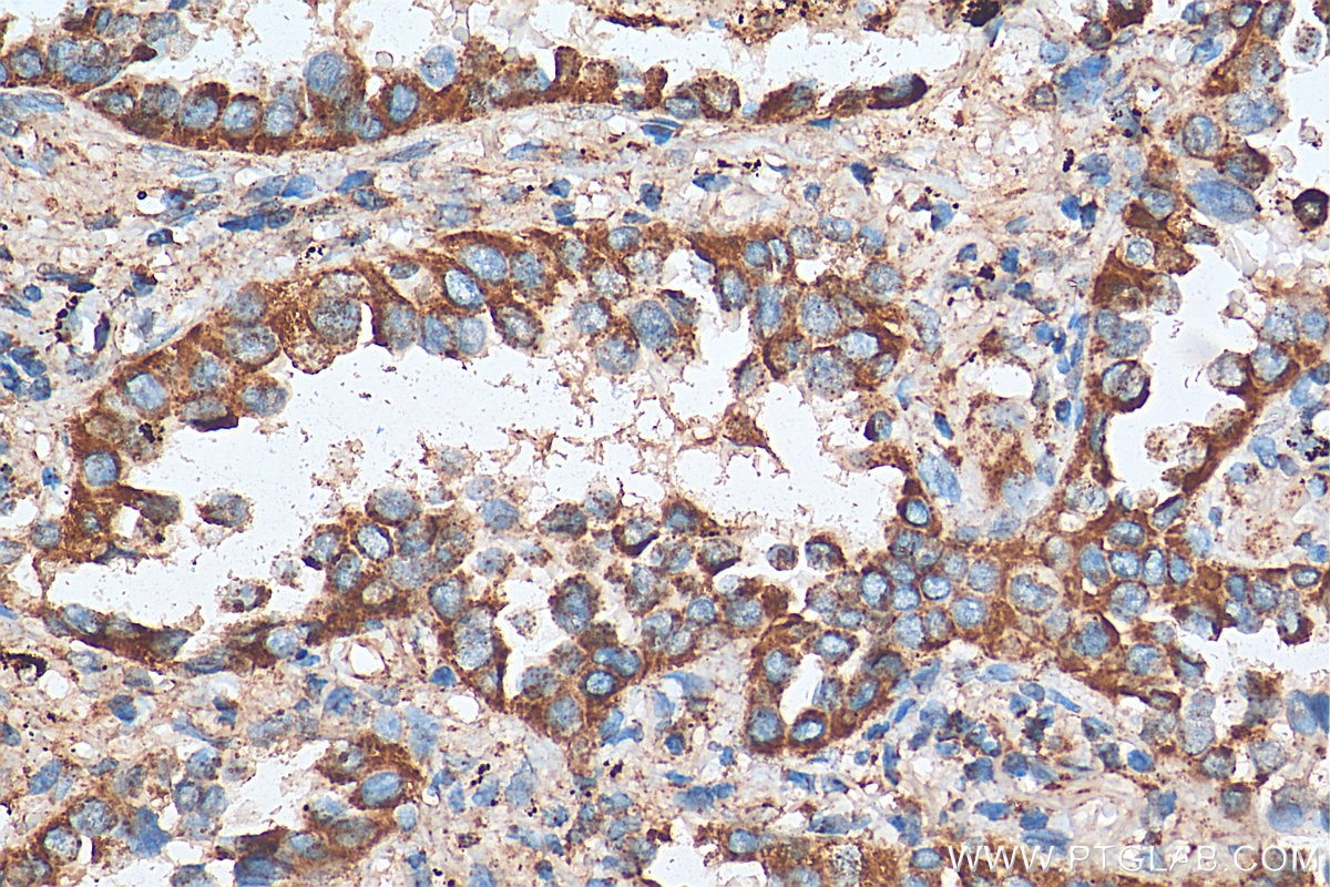 Immunohistochemistry (IHC) staining of human lung cancer tissue using ACAA2 Polyclonal antibody (11111-1-AP)