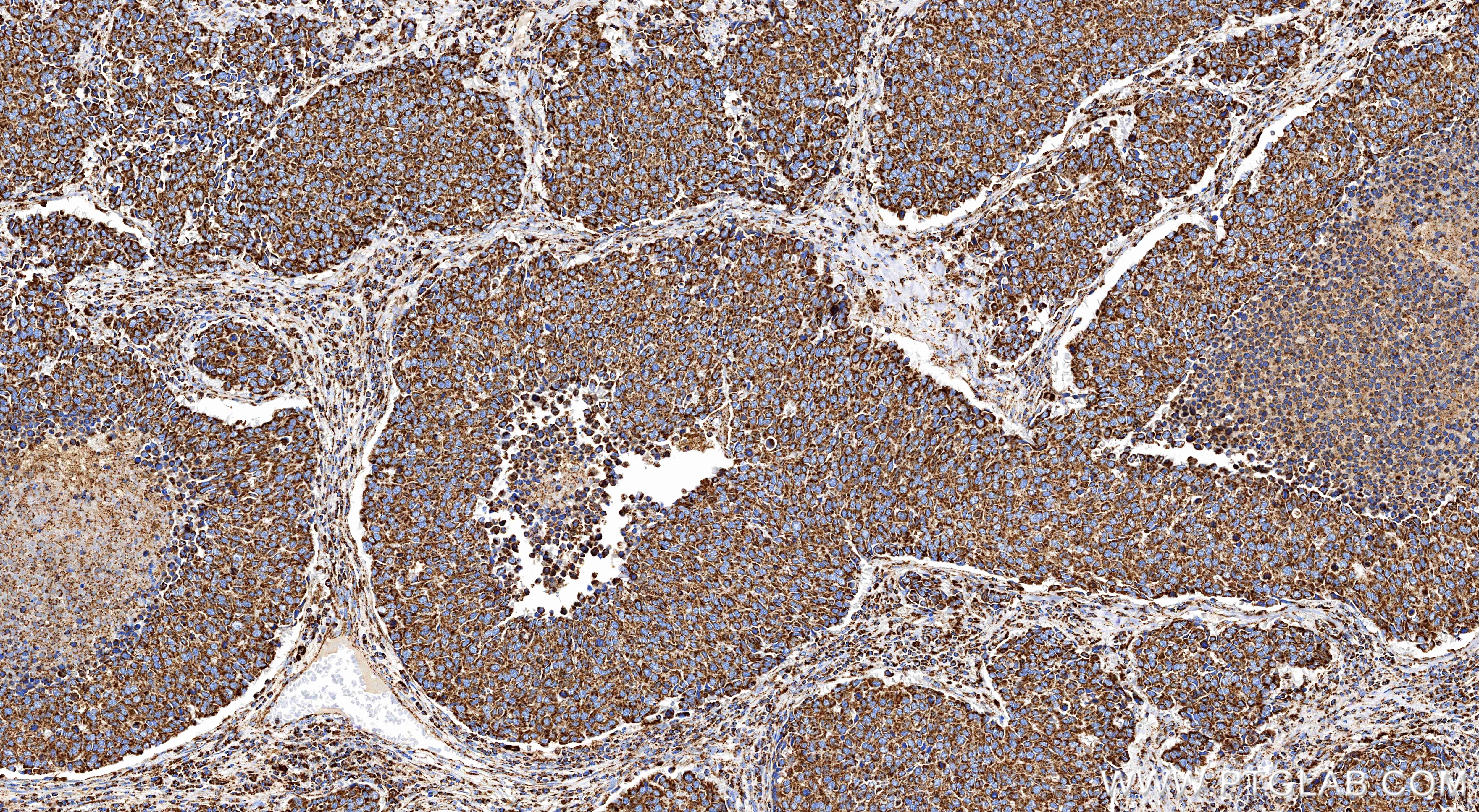 Immunohistochemistry (IHC) staining of Human Small Cell Lung Cancer using ACAA2 Recombinant monoclonal antibody (86161-3-RR)