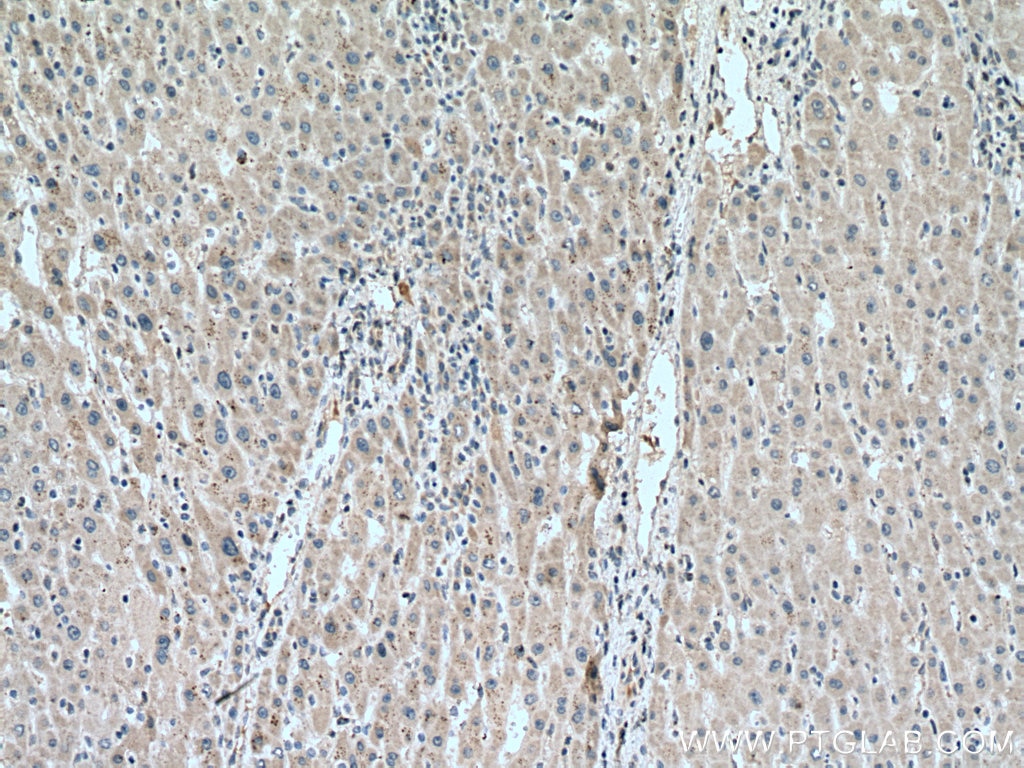 Immunohistochemistry (IHC) staining of human liver cancer tissue using ACAD9 Polyclonal antibody (15770-1-AP)