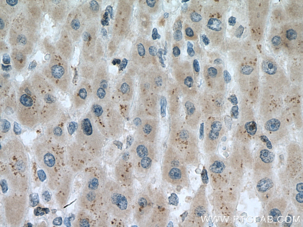 Immunohistochemistry (IHC) staining of human liver cancer tissue using ACAD9 Polyclonal antibody (15770-1-AP)