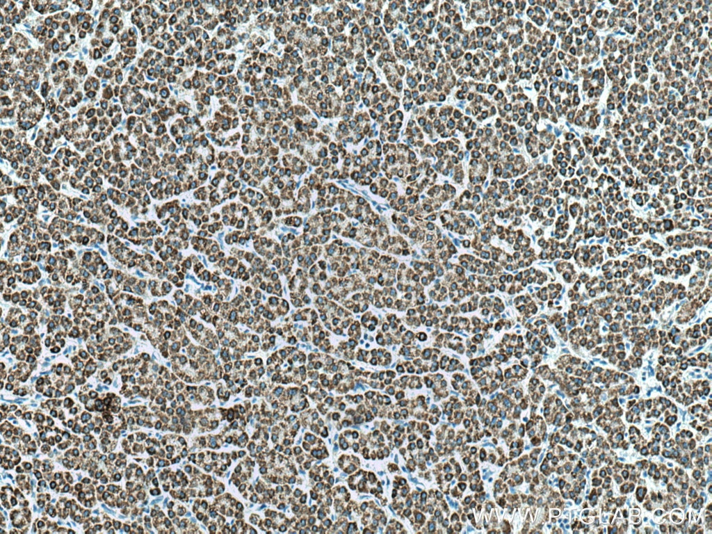 IHC staining of human liver cancer using 17442-1-AP