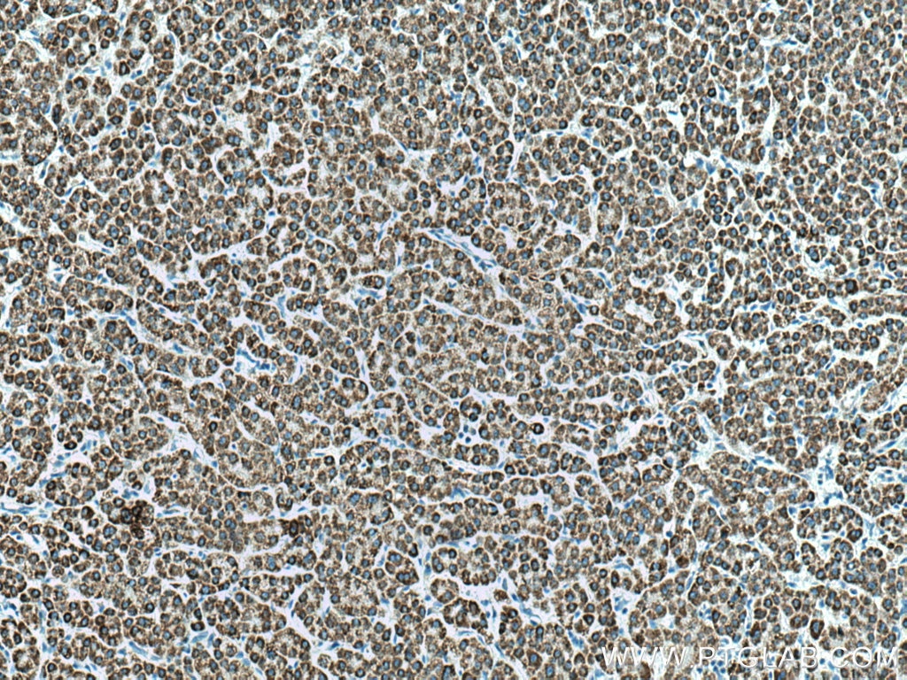 Immunohistochemistry (IHC) staining of human liver cancer tissue using ACADL Polyclonal antibody (17442-1-AP)