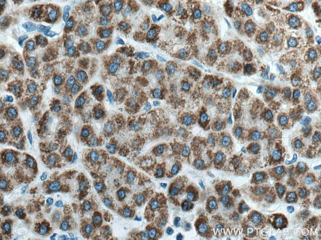 Immunohistochemistry (IHC) staining of human liver cancer tissue using ACADL Polyclonal antibody (17442-1-AP)