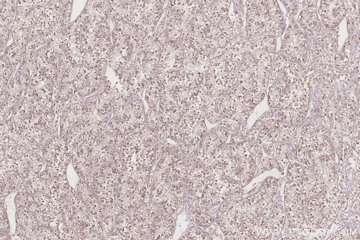 Immunohistochemistry (IHC) staining of human renal cell carcinoma tissue using ACADL Polyclonal antibody (17442-1-AP)