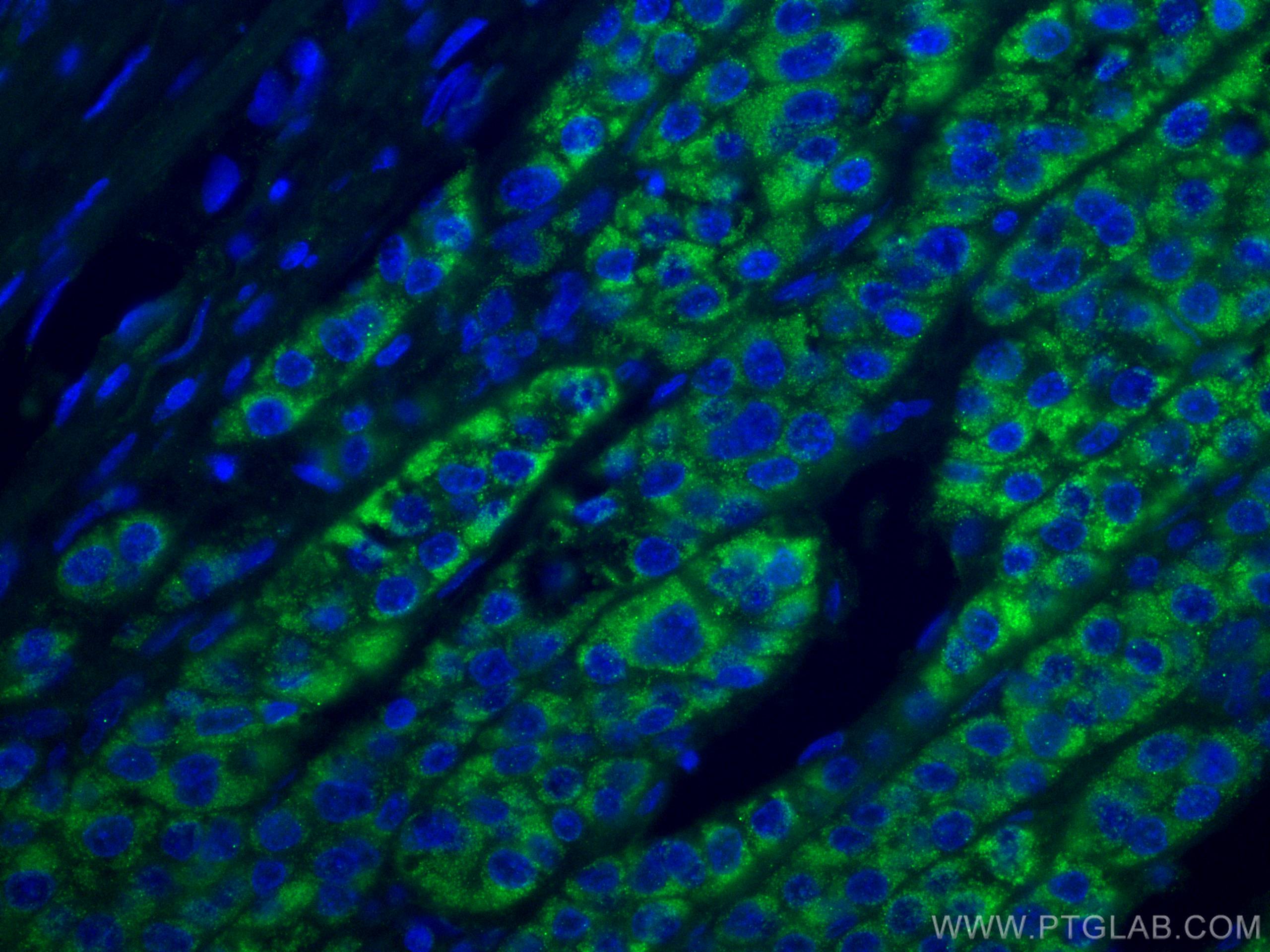 Immunofluorescence (IF) / fluorescent staining of human liver cancer tissue using ACADM Monoclonal antibody (67742-1-Ig)