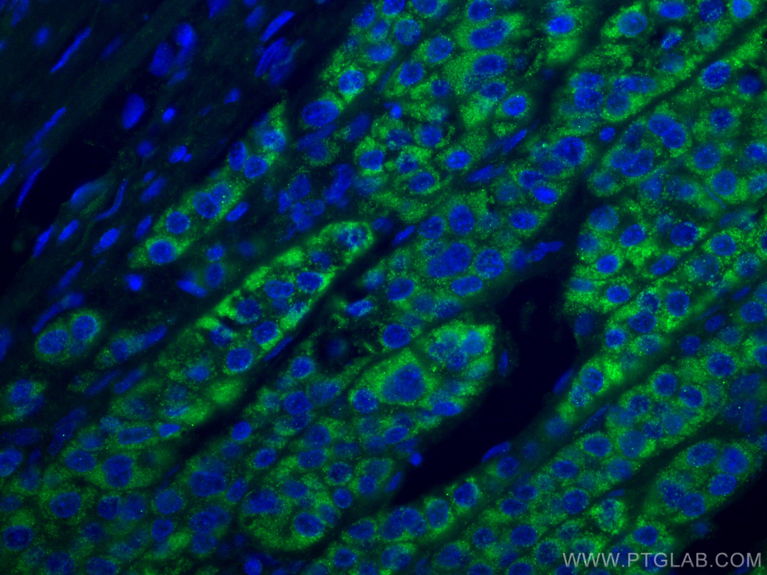 Immunofluorescence (IF) / fluorescent staining of human liver cancer tissue using ACADM Monoclonal antibody (67742-1-Ig)