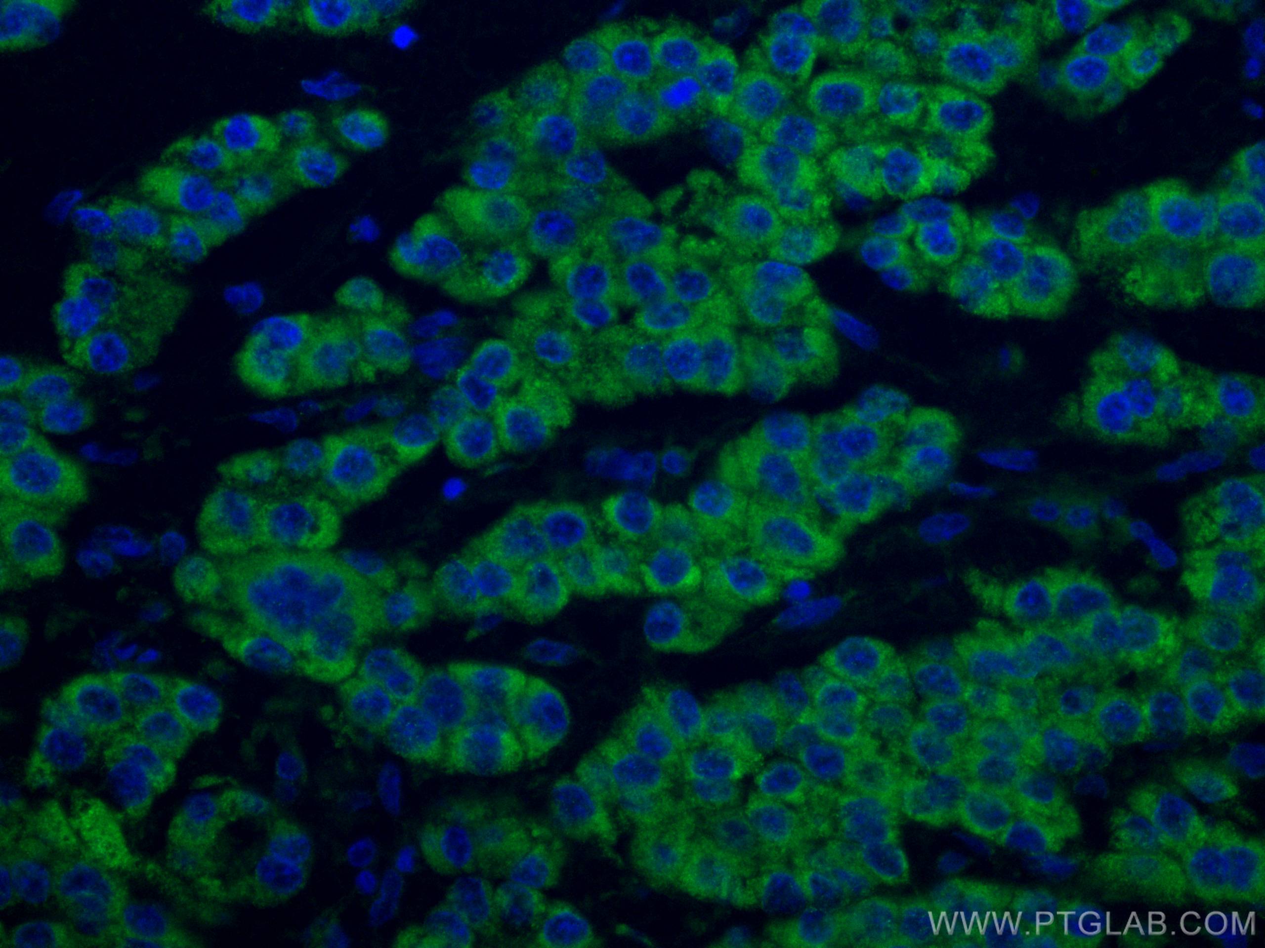 IF Staining of human liver cancer using CL488-67742