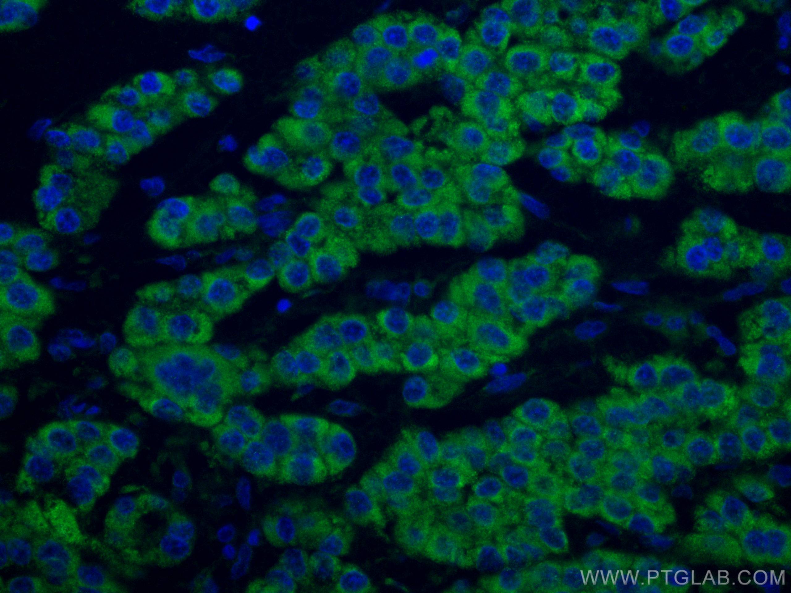 Immunofluorescence (IF) / fluorescent staining of human liver cancer tissue using CoraLite® Plus 488-conjugated ACADM Monoclonal ant (CL488-67742)