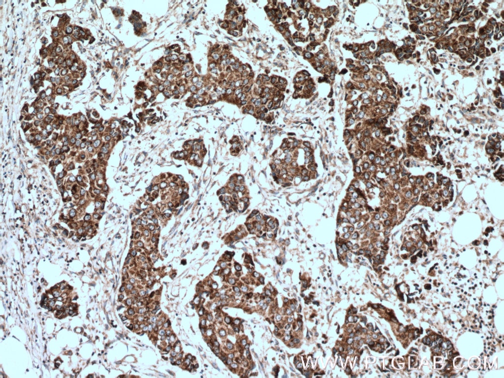 Immunohistochemistry (IHC) staining of human breast cancer tissue using ACADSB Polyclonal antibody (13122-1-AP)