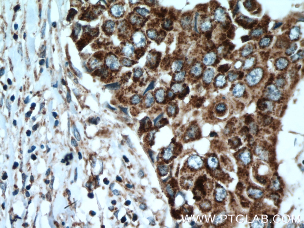 Immunohistochemistry (IHC) staining of human breast cancer tissue using ACADSB Polyclonal antibody (13122-1-AP)