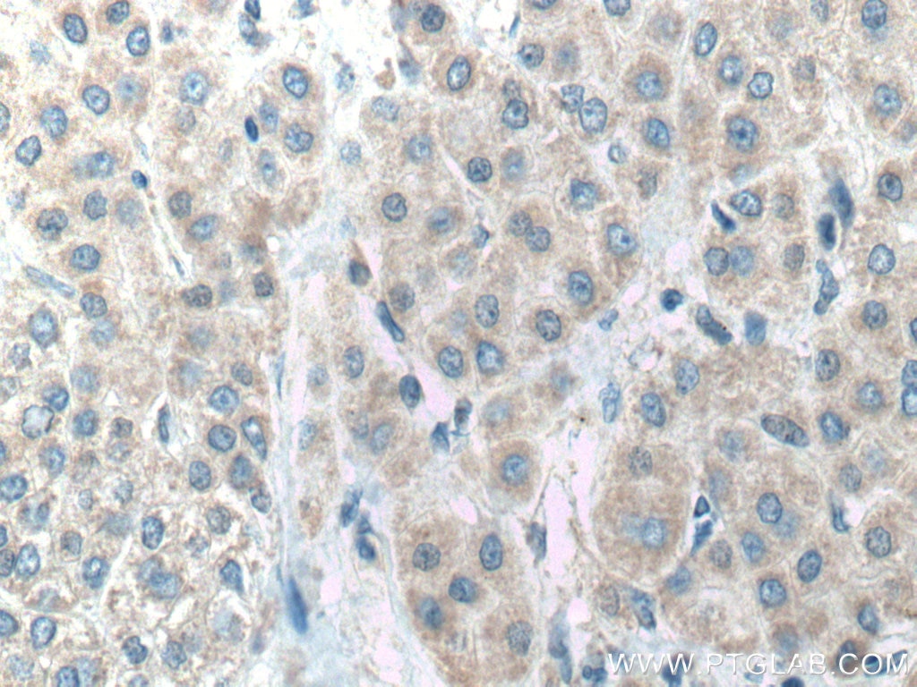 Immunohistochemistry (IHC) staining of human liver cancer tissue using ACADVL Polyclonal antibody (14527-1-AP)