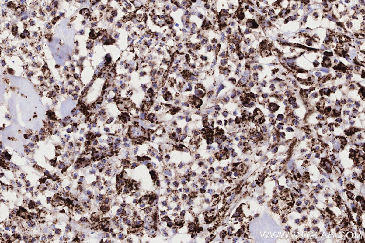 Immunohistochemistry (IHC) staining of human colon cancer tissue using ACADVL Recombinant monoclonal antibody (85889-1-RR)