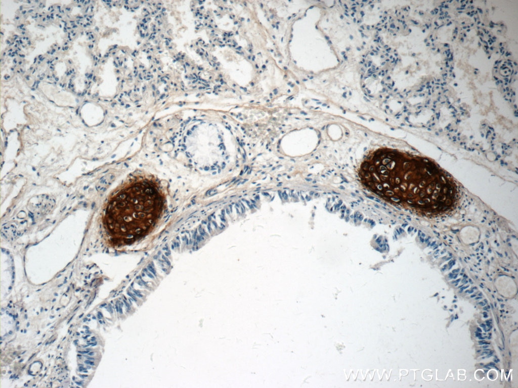 Immunohistochemistry (IHC) staining of human lung tissue using Aggrecan Polyclonal antibody (13880-1-AP)