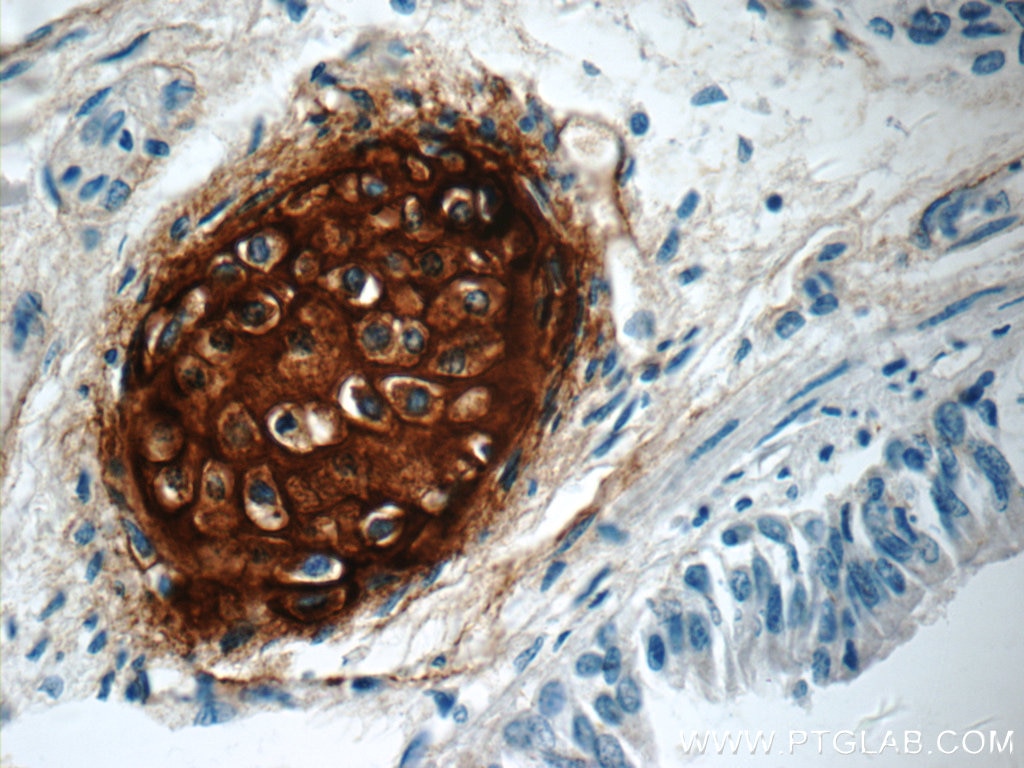 Immunohistochemistry (IHC) staining of human lung tissue using Aggrecan Polyclonal antibody (13880-1-AP)