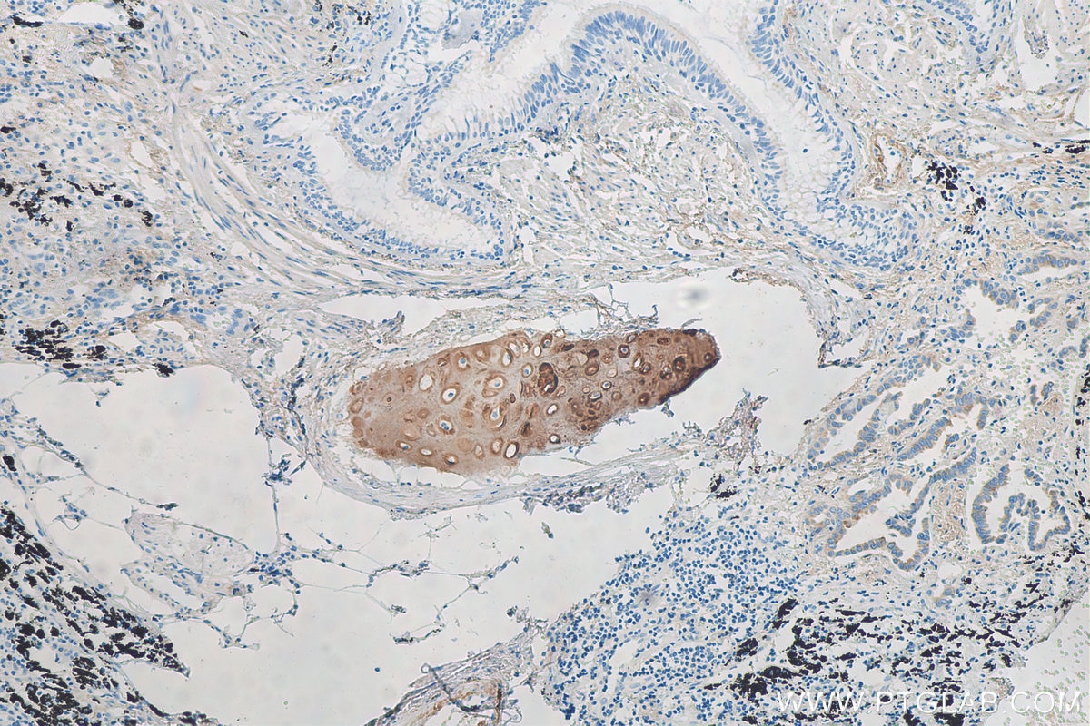 Immunohistochemistry (IHC) staining of human lung cancer tissue using Aggrecan Polyclonal antibody (13880-1-AP)