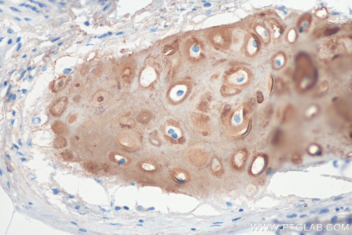 Immunohistochemistry (IHC) staining of human lung cancer tissue using Aggrecan Polyclonal antibody (13880-1-AP)