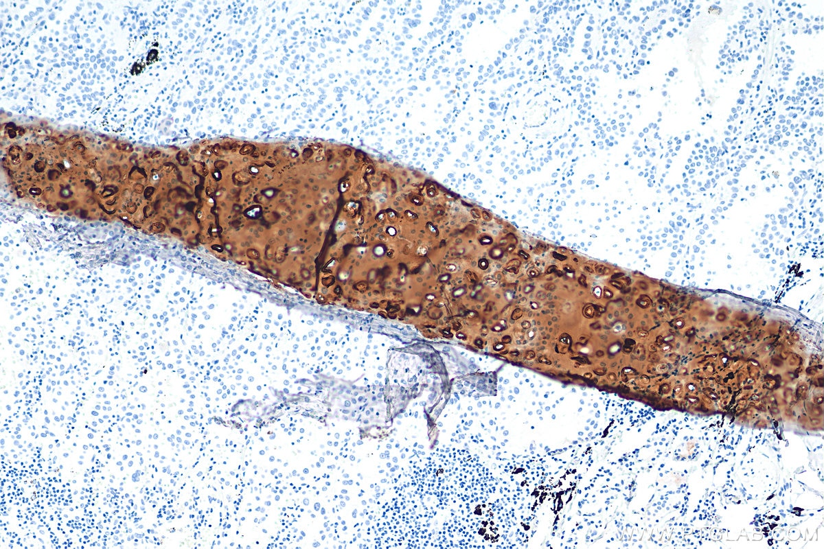 Immunohistochemistry (IHC) staining of human lung cancer tissue using ACAN Monoclonal antibody (68350-1-Ig)