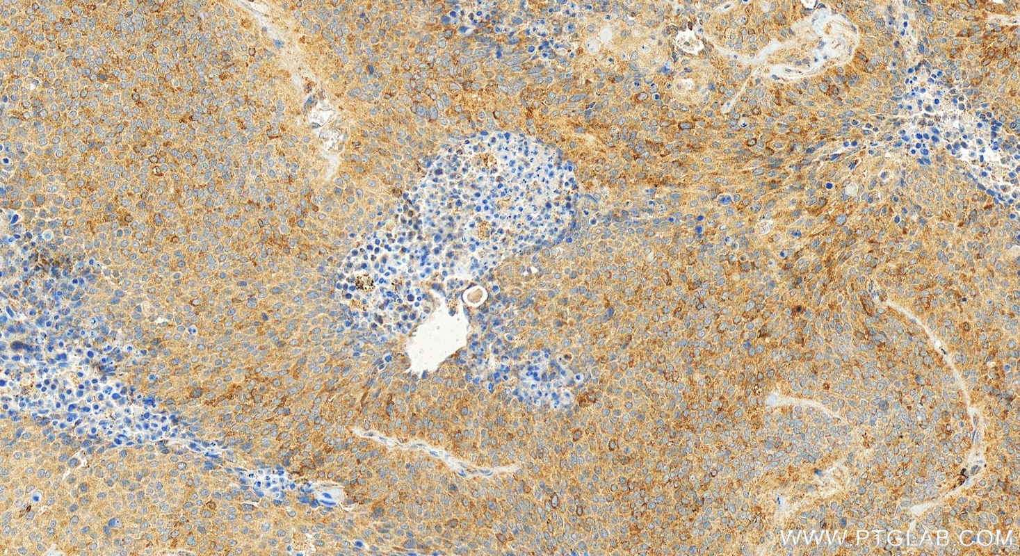 Immunohistochemical analysis of paraffin-embedded human lung squamous cell cancer slide using 20135-1-AP (ACAP1 antibody) at dilution of 1:400 (under 20x lens). Heat mediated antigen retrieval with Tris-EDTA buffer (pH 9.0). Immunohistochemistry (IHC) staining of human lung squamous cell cancer using ACAP1 Polyclonal antibody (20135-1-AP)
