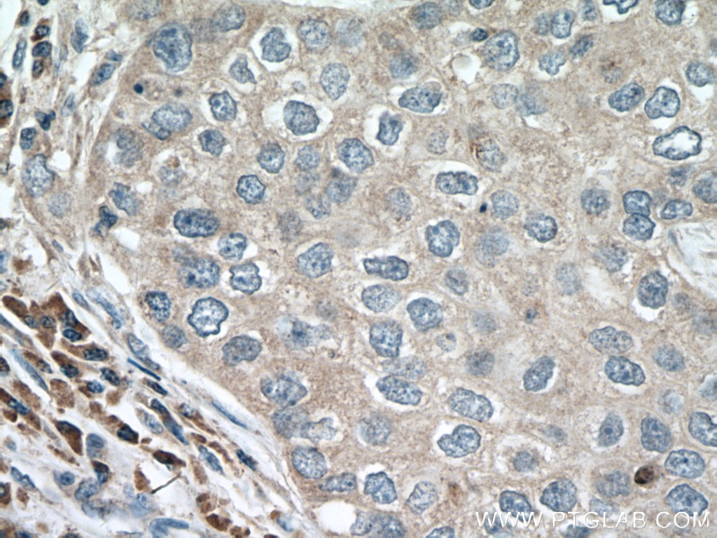 Immunohistochemistry (IHC) staining of human breast cancer tissue using ACAP1 Monoclonal antibody (66596-1-Ig)