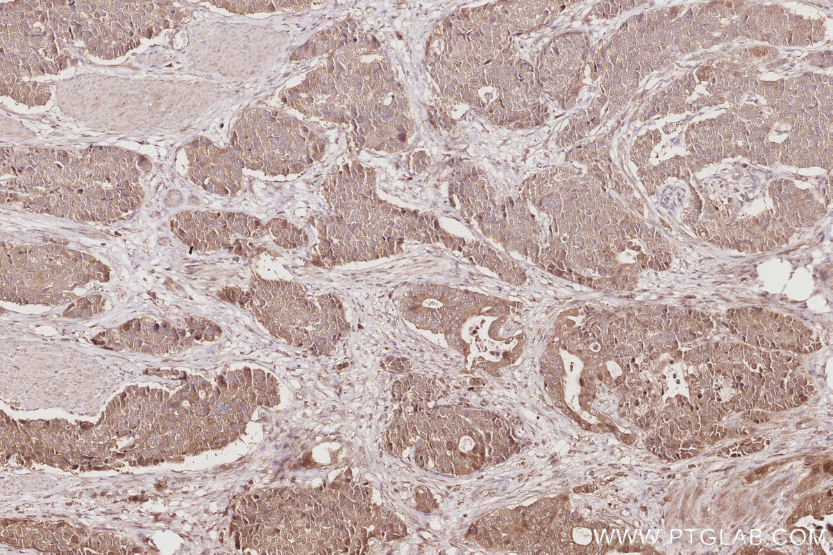 Immunohistochemistry (IHC) staining of human stomach cancer tissue using ACBD3 Polyclonal antibody (14096-1-AP)