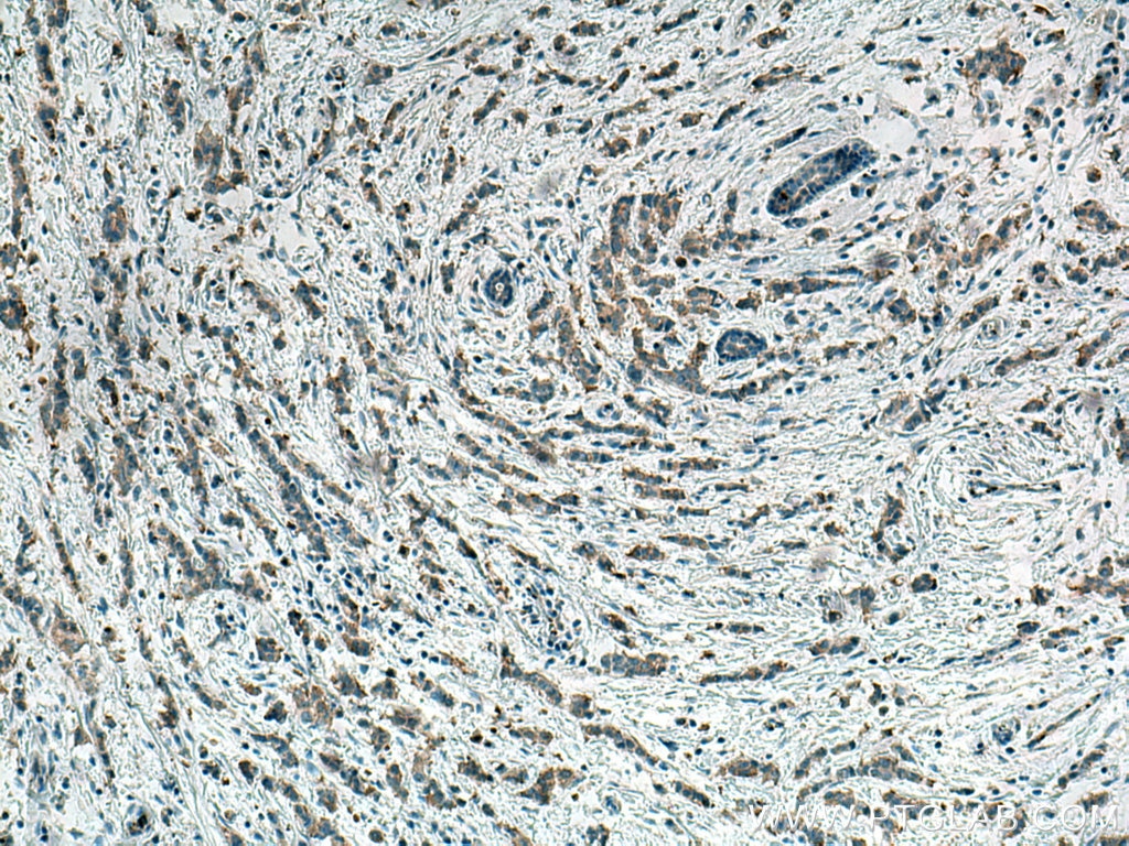 Immunohistochemistry (IHC) staining of human breast cancer tissue using ACC1 Monoclonal antibody (67373-1-Ig)