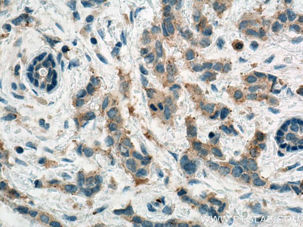 IHC staining of human breast cancer using 67373-1-Ig