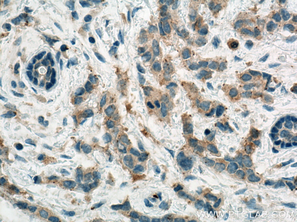 Immunohistochemistry (IHC) staining of human breast cancer tissue using ACC1 Monoclonal antibody (67373-1-Ig)