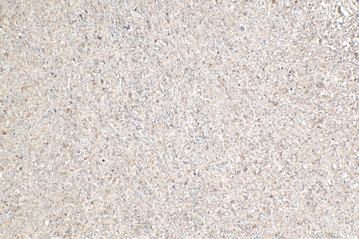 IHC staining of human lymphoma using 11491-1-AP Immunohistochemistry (IHC) staining of human lymphoma tissue using PHACS Polyclonal antibody (11491-1-AP)