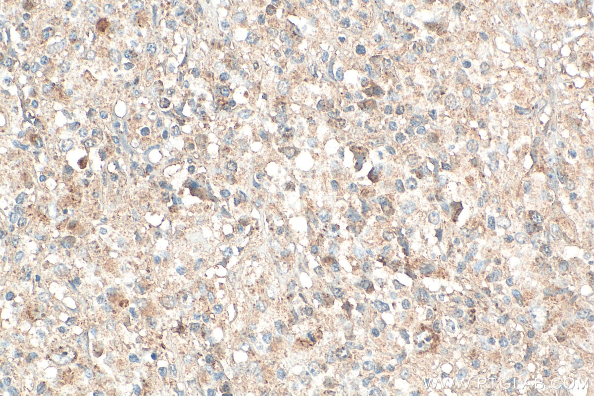 IHC staining of human lymphoma using 11491-1-AP Immunohistochemistry (IHC) staining of human lymphoma tissue using PHACS Polyclonal antibody (11491-1-AP)