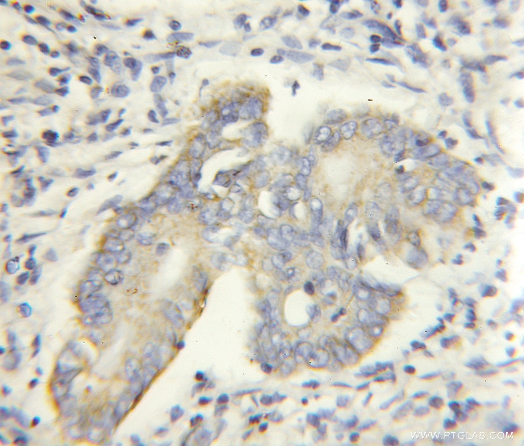 Immunohistochemistry (IHC) staining of human colon cancer tissue using PHACS Polyclonal antibody (11491-1-AP)