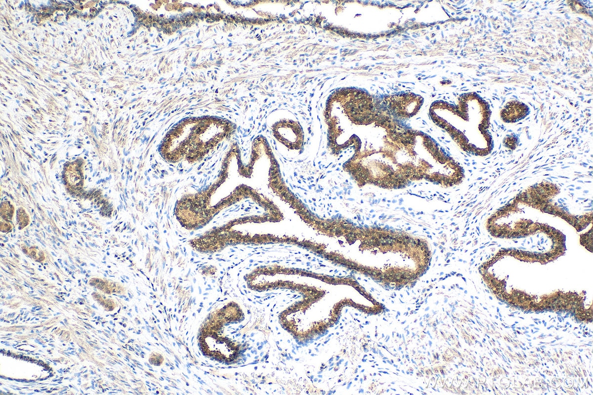 Immunohistochemistry (IHC) staining of human prostate cancer tissue using ACLY Polyclonal antibody (15421-1-AP)