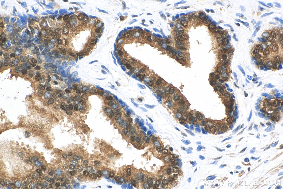 Immunohistochemistry (IHC) staining of human prostate cancer tissue using ACLY Polyclonal antibody (15421-1-AP)