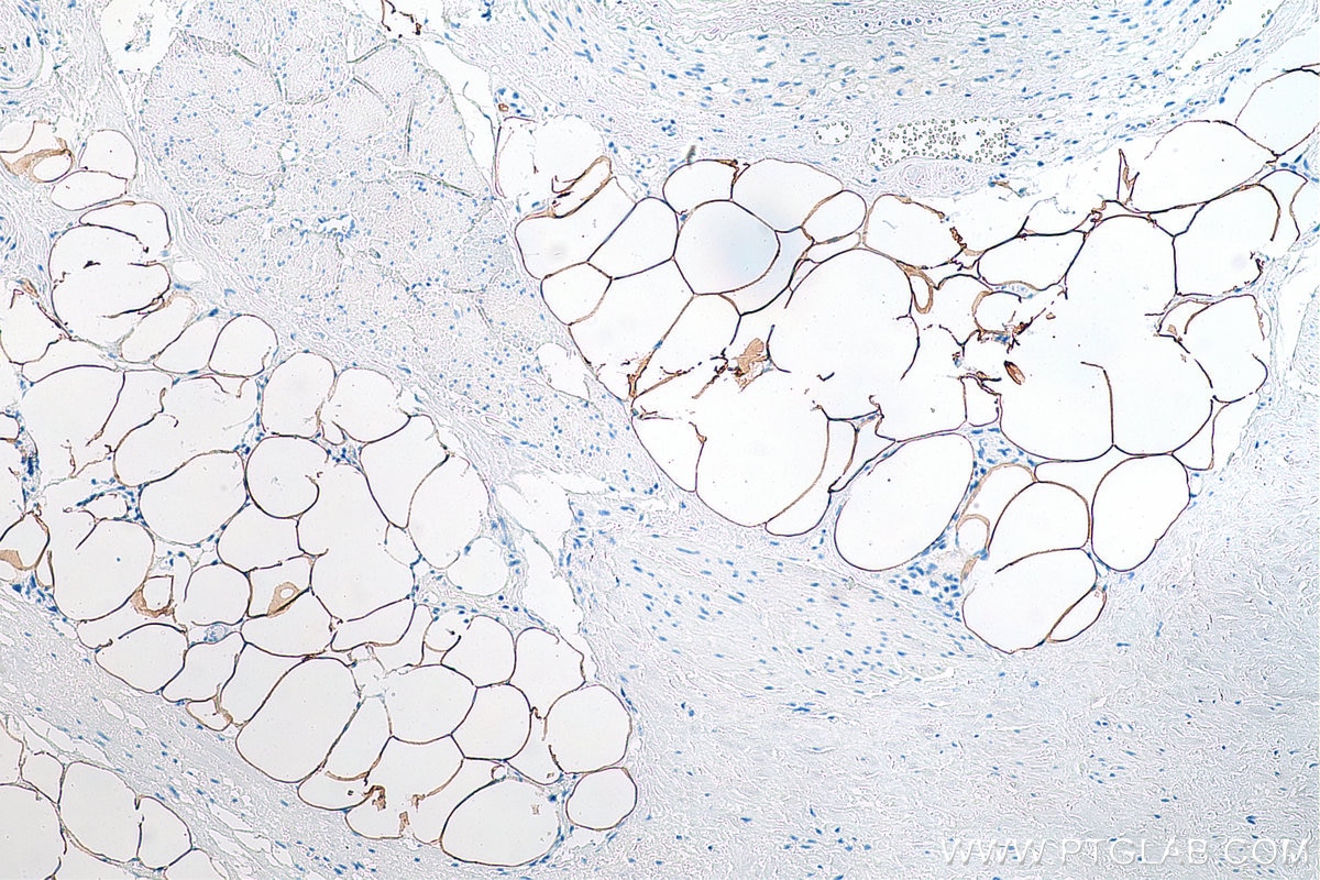 Immunohistochemistry (IHC) staining of human prostate cancer tissue using ACLY Monoclonal antibody (67166-1-Ig)