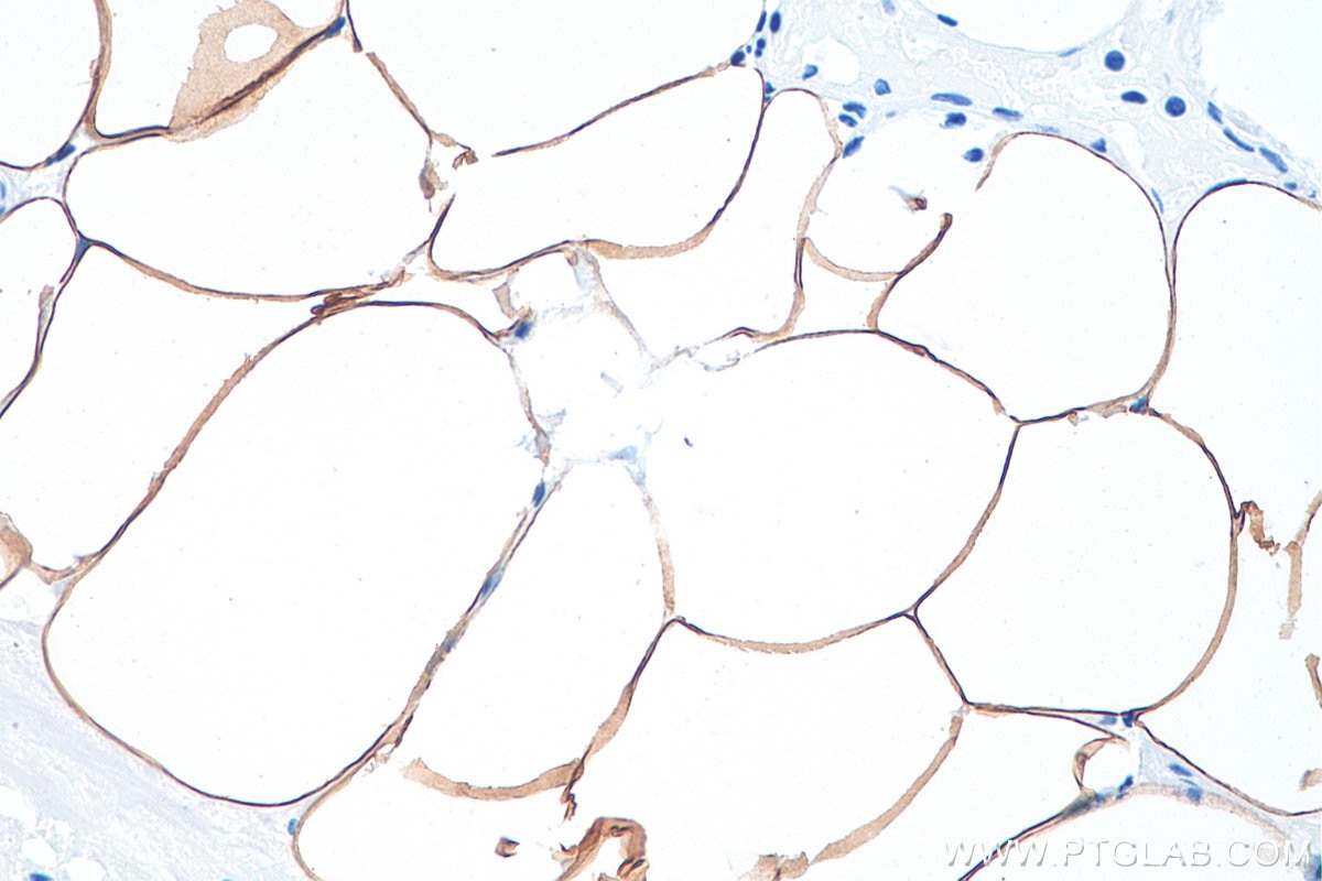 Immunohistochemistry (IHC) staining of human prostate cancer tissue using ACLY Monoclonal antibody (67166-1-Ig)