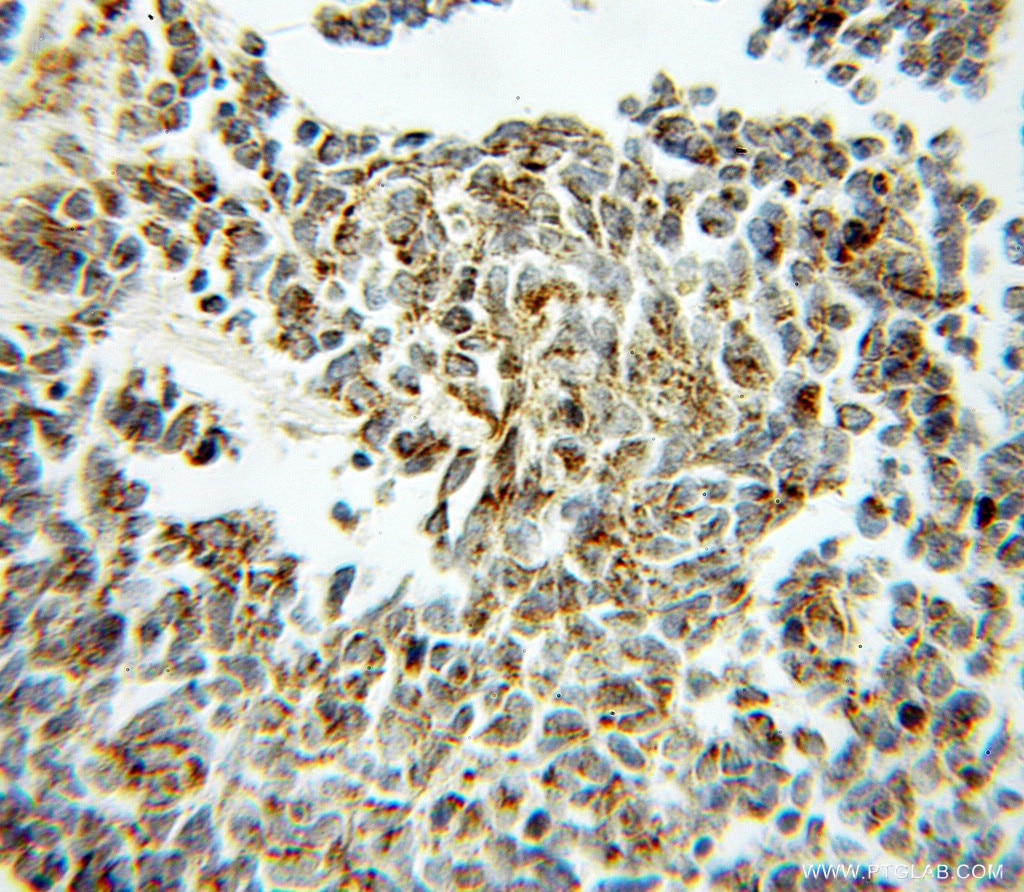 IHC staining of human lung cancer using 11134-1-AP