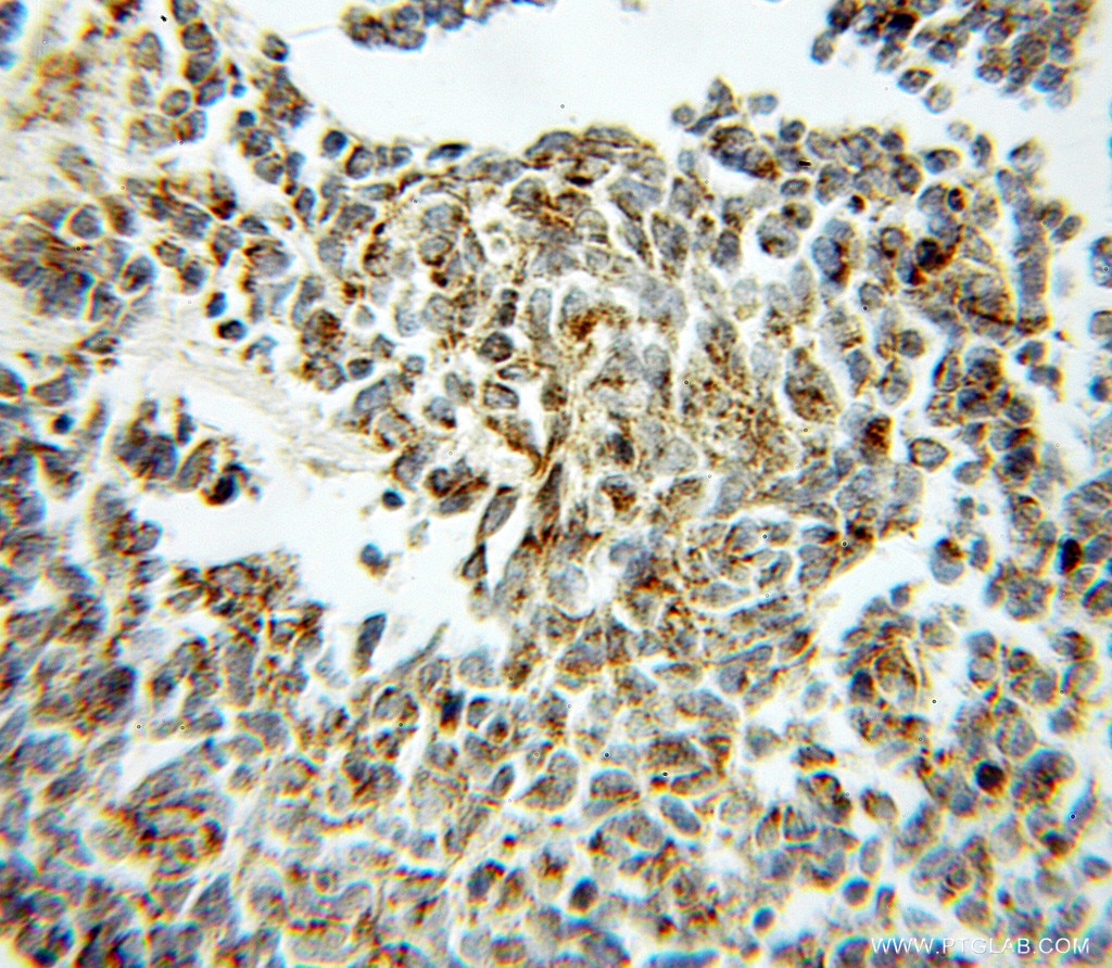 Immunohistochemistry (IHC) staining of human lung cancer tissue using Aconitase 2 Polyclonal antibody (11134-1-AP)