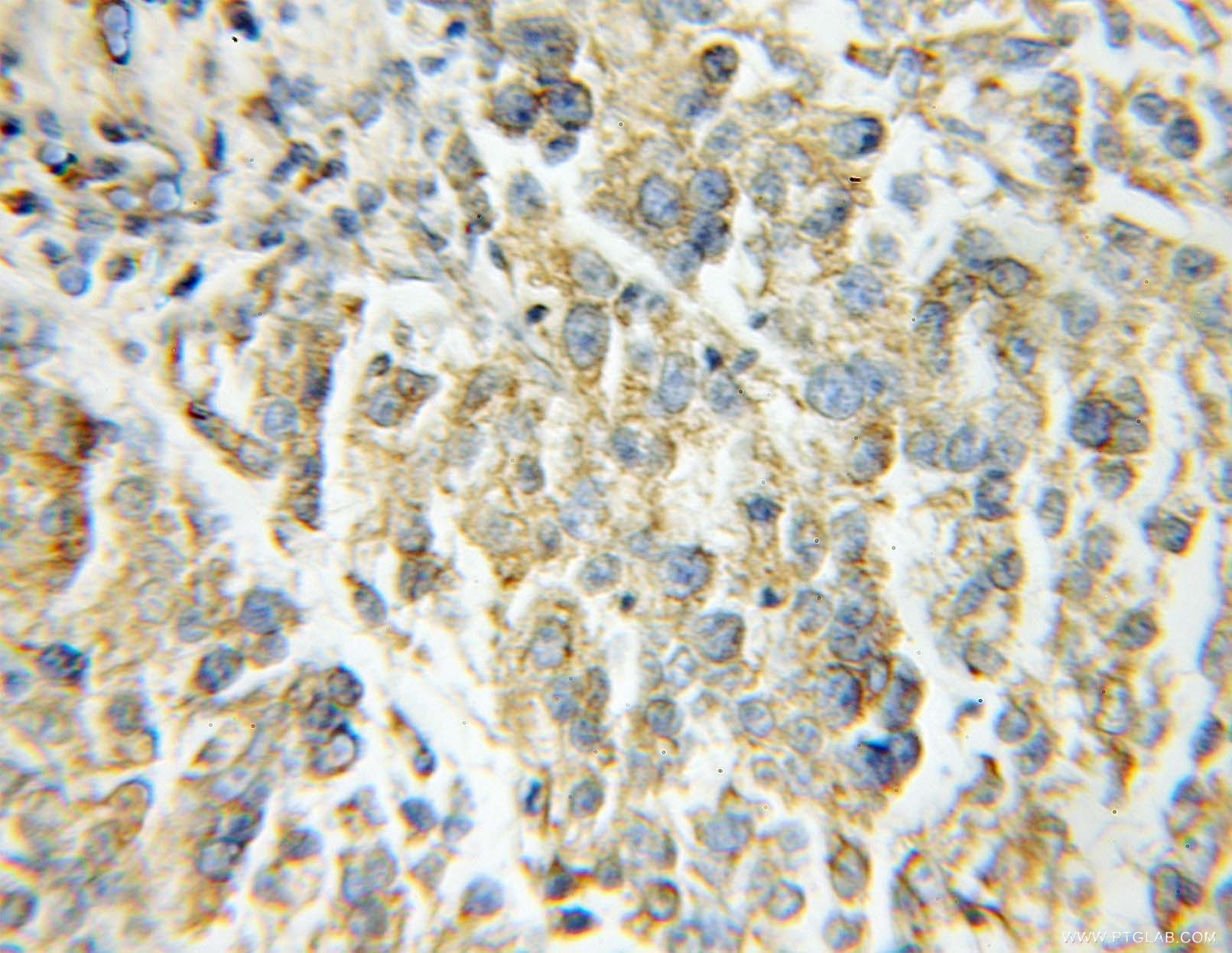 Immunohistochemistry (IHC) staining of human lung cancer tissue using Aconitase 2 Polyclonal antibody (11134-1-AP)