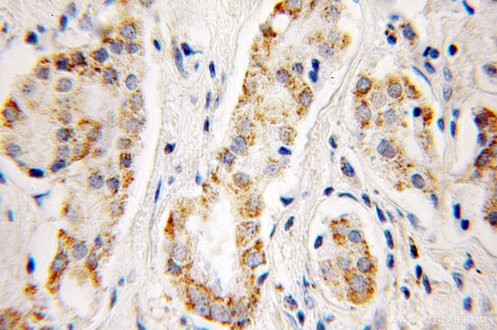 Immunohistochemistry (IHC) staining of human prostate cancer tissue using Aconitase 2 Polyclonal antibody (11134-1-AP)