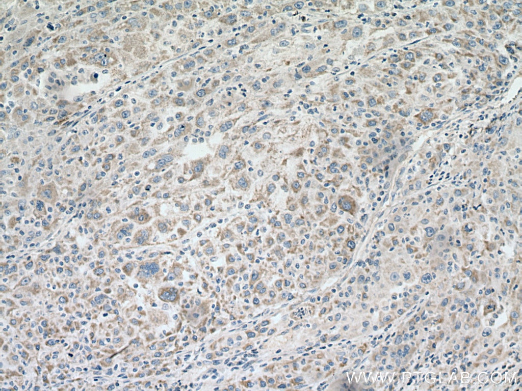 IHC staining of human liver cancer using 67509-1-Ig