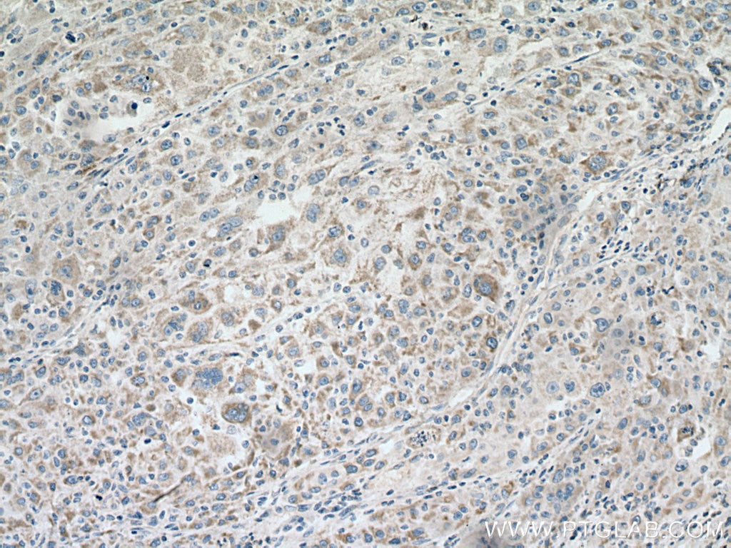 Immunohistochemistry (IHC) staining of human liver cancer tissue using ACO2 Monoclonal antibody (67509-1-Ig)