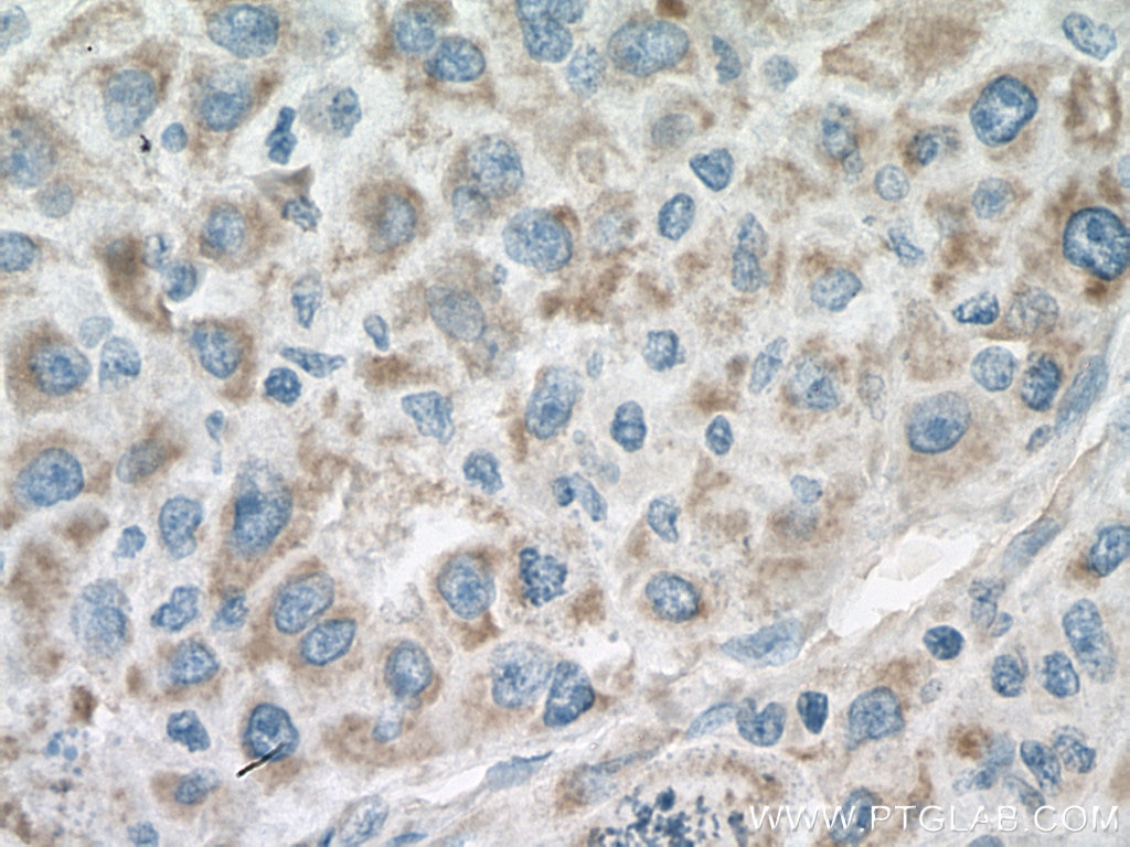 Immunohistochemistry (IHC) staining of human liver cancer tissue using ACO2 Monoclonal antibody (67509-1-Ig)
