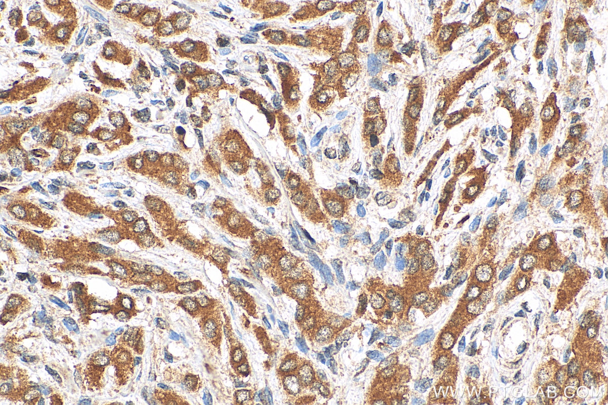 Immunohistochemistry (IHC) staining of human prostate cancer tissue using ACOT11 Polyclonal antibody (10776-1-AP)