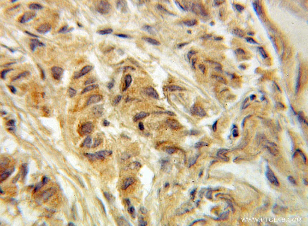 Immunohistochemistry (IHC) staining of human prostate cancer tissue using ACOT11 Polyclonal antibody (10776-1-AP)