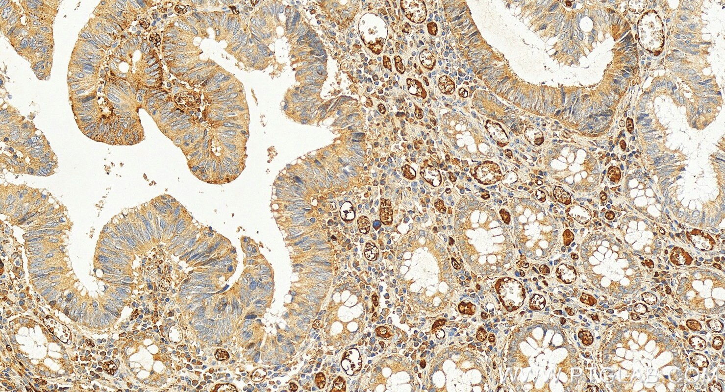 Immunohistochemistry (IHC) staining of human colon cancer tissue using ACOT12 Polyclonal antibody (17871-1-AP)