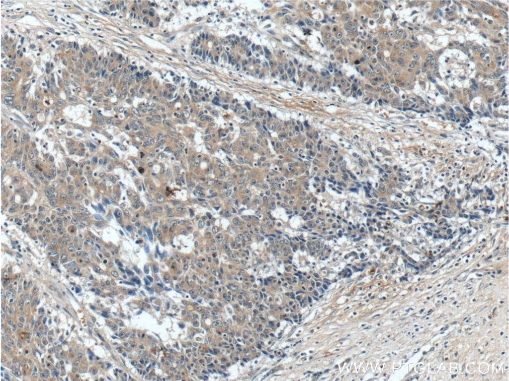 Immunohistochemistry (IHC) staining of human colon cancer tissue using ACOT12 Polyclonal antibody (17871-1-AP)