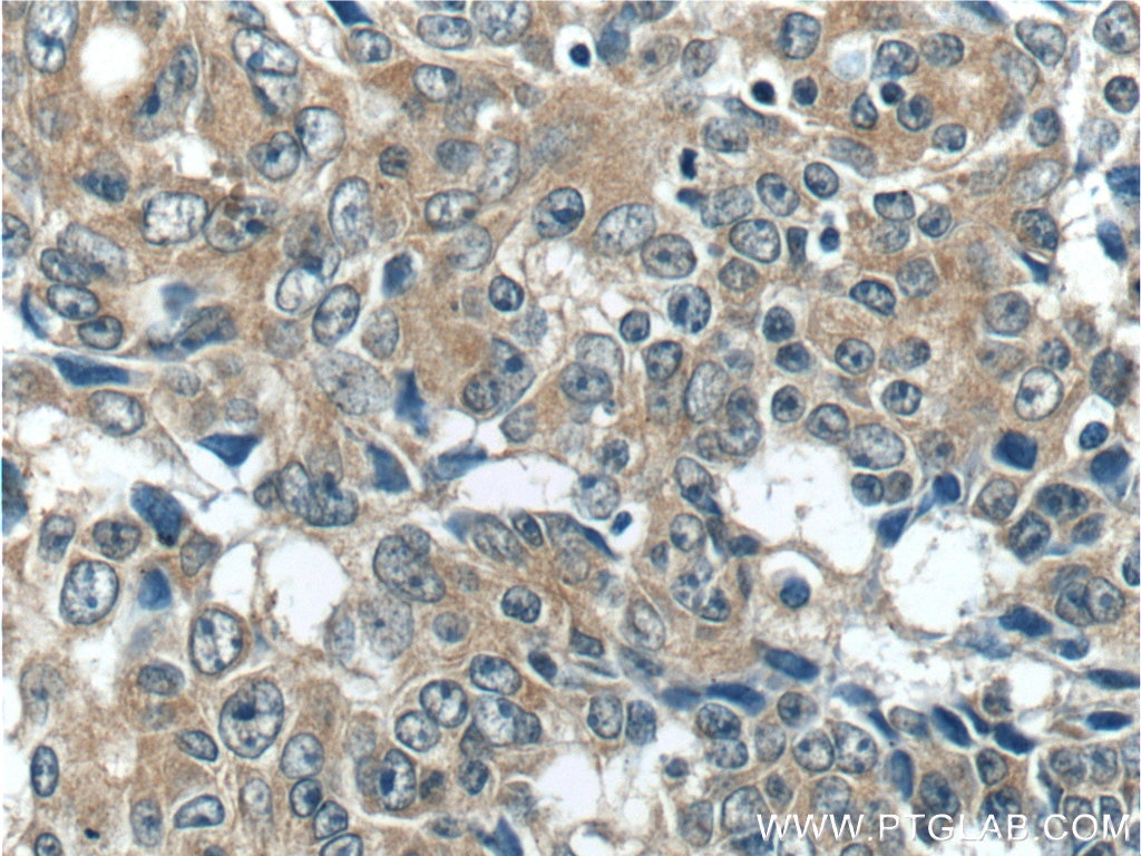 Immunohistochemistry (IHC) staining of human colon cancer tissue using ACOT12 Polyclonal antibody (17871-1-AP)