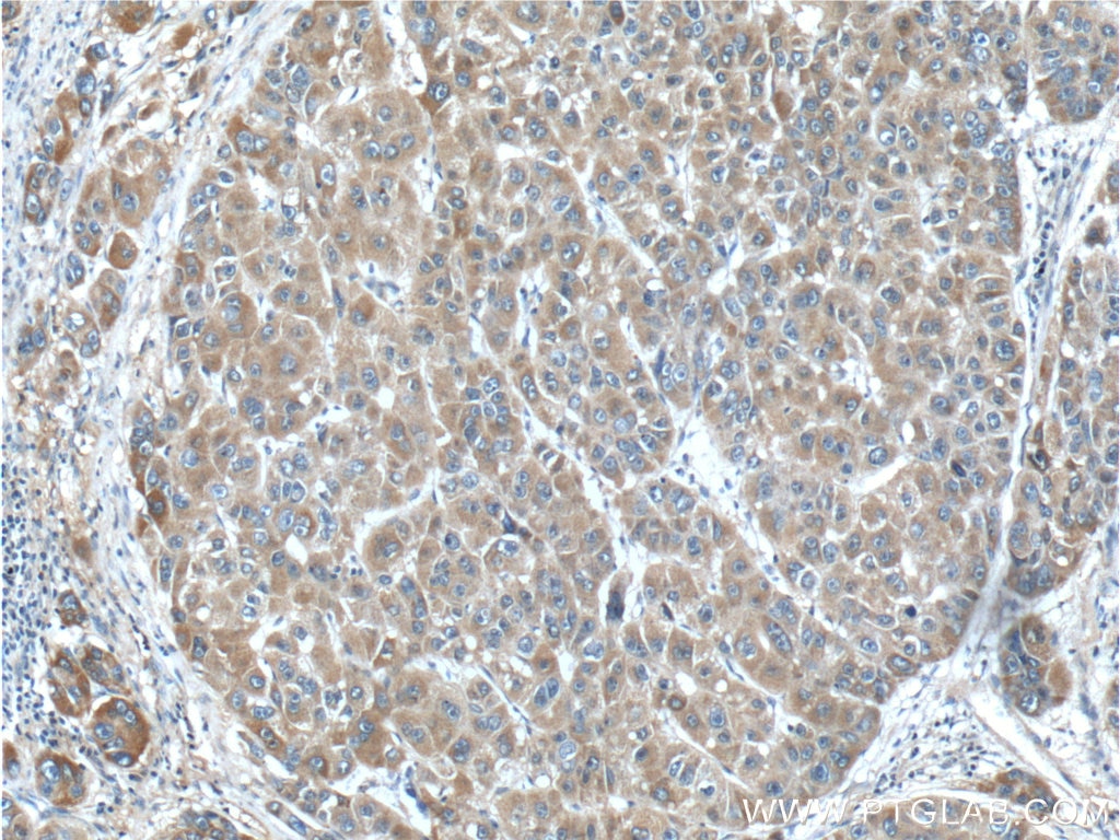 Immunohistochemistry (IHC) staining of human liver cancer tissue using ACOT12 Polyclonal antibody (17871-1-AP)